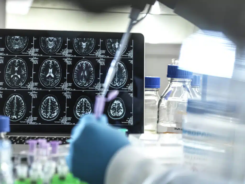 Investigadores desarrollan análisis de sangre que pueden detectar de forma fiable la enfermedad de Alzheimer